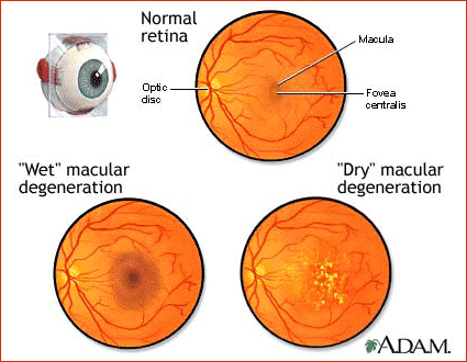 Two types of age-related macular degeneration.