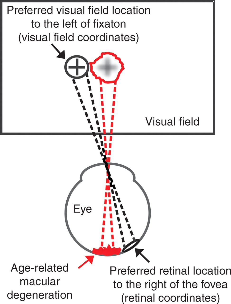 Eccentric viewing techniques to help restore some vision.